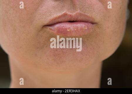 Close-up di labbri di sesso femminile affetti da herpes malattia Foto Stock