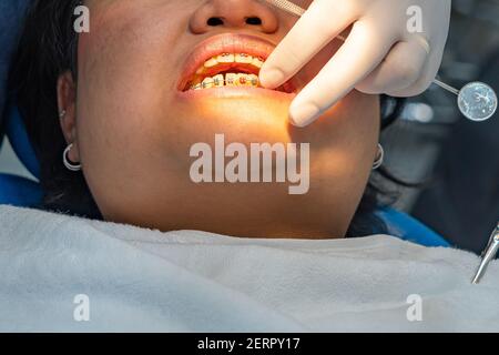Primo piano foto di paziente femminile che indossa denti rinforzi avendo controllo dentale Foto Stock