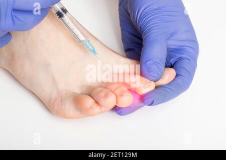 Il medico effettua un'iniezione tra i piedi contro iperidrosi sudorazione. Concetto sgradevole di trattamento dell'odore del piede Foto Stock