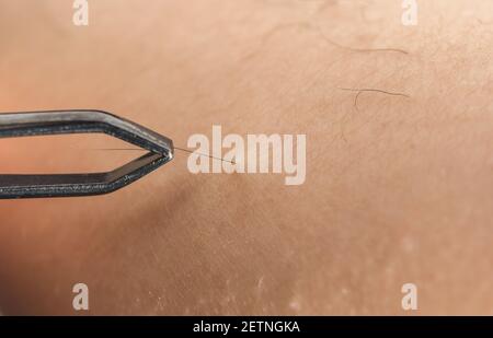 dettaglio della donna in primo piano con le pinzette a coppia, rimuovendo i capelli dalla gamba pelosa Foto Stock