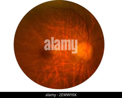 Retina del diabete , retinopatia diabetica,foto Medicina Retina anormale isolato su sfondo bianco.salvato con percorso di ritaglio Foto Stock