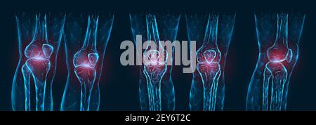 Dolore, lesione o infiammazione nelle ginocchia illustrazione vettoriale poligonale. Modello poly basso di articolazioni dolenti del ginocchio. Illustrazione Vettoriale