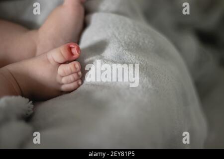 Vista ravvicinata del chiodo di ingrowing sulla punta del bambino con segni di infiammazione Foto Stock