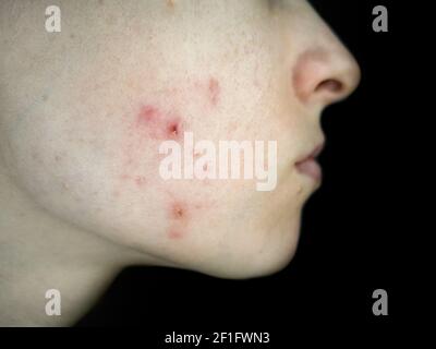 Primo piano di una guancia donna con infezione rossa acne. Problema della pelle. Foto Stock