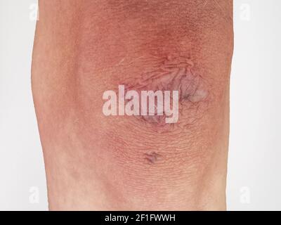 Closeup della cicatrice del ginocchio su bianco Foto Stock