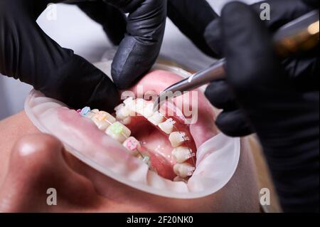 Primo piano delle mani del dentista in guanti neri che fanno la procedura dentale, il processo di fissaggio di bretelle in ceramica bianca e filo d'acciaio con l'aiuto di pinze. Divaricatore guancia in lattice sulla bocca Foto Stock