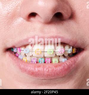 Primo piano istantanea del bel sorriso della donna, che mostra denti bianchi sani con bretelle in ceramica, uniti con un filo e colorati fasce in gomma. Concetto di odontoiatria e ortodonzia Foto Stock