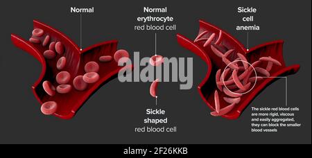 La malattia a cellule falciformi è un gruppo di disturbi del sangue. Anemia falciforme. Ciò provoca un'anomalia nell'emoglobina proteica che trasporta ossigeno Foto Stock