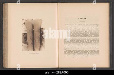 Paziente affetto da malattia della pelle 'purpura simplex'; purpurpura simplex .. Foto Stock