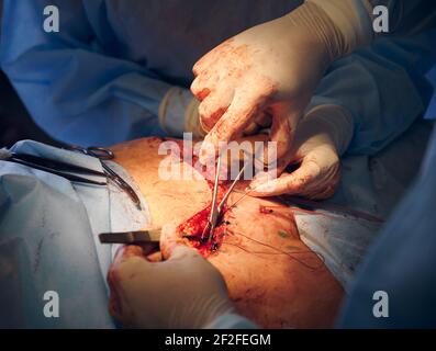 Medico e assistente che posiziona le suture dopo l'intervento di abdominoplastica. Foto Stock