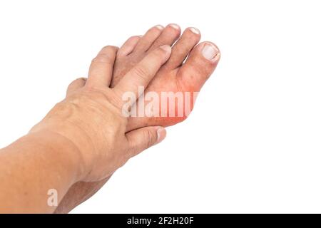 Mano abbracciando piede infiammato con gotta dolorosa Foto Stock