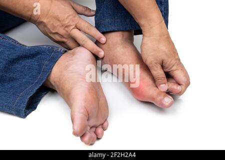 Mano abbracciando piede infiammato con gotta dolorosa Foto Stock