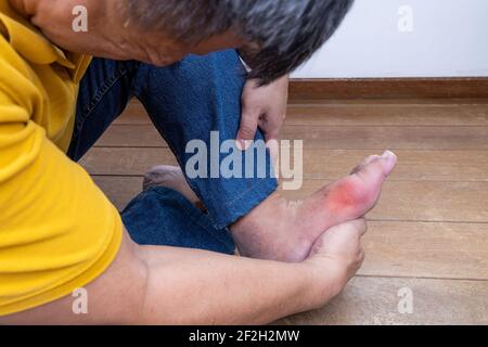 Uomo asiatico con mano che abbraccia il piede infiammato con gotta dolorosa Foto Stock