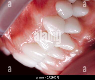 Perfetto sorriso chirurgia veneers candeggina di protesi arco zircone ceramica impianti corone. Paziente in clinica di restauro dentale. Risultato di pro orale Foto Stock