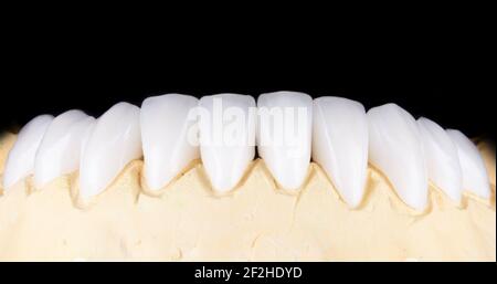 Perfetto sorriso prima e dopo veneer candeggina di protesi con arco in ceramica Zircon corone impianti. Paziente in clinica di restauro dentale. Risultato di Foto Stock