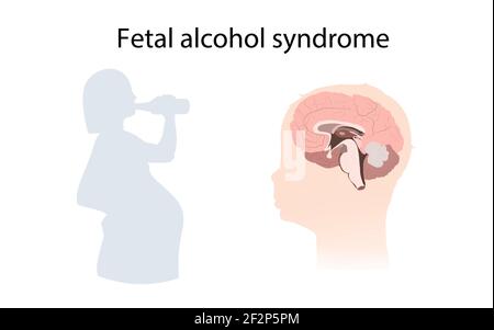 Sindrome da alcol fetale, illustrazione Foto Stock