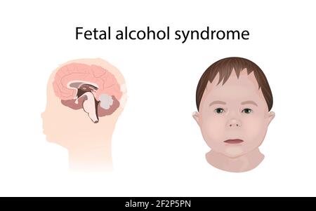 Sindrome da alcol fetale, illustrazione Foto Stock