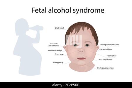 Sindrome da alcol fetale, illustrazione Foto Stock