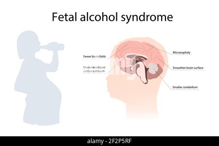 Sindrome da alcol fetale, illustrazione Foto Stock