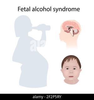 Sindrome da alcol fetale, illustrazione Foto Stock