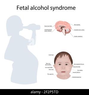 Sindrome da alcol fetale, illustrazione Foto Stock