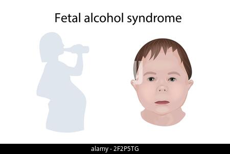 Sindrome da alcol fetale, illustrazione Foto Stock