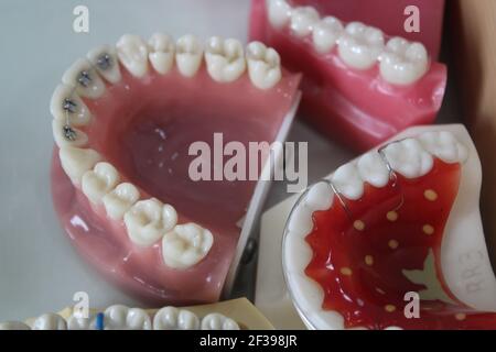 Primo piano di modelli dentali in plastica che mostrano diversi tipi di ortodontici trattamento Foto Stock