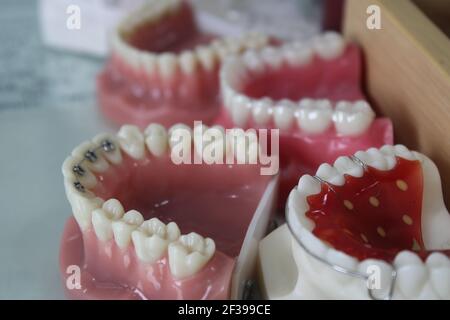 Closeup di modelli dentali che mostrano diversi tipi di trattamento ortodontico Foto Stock