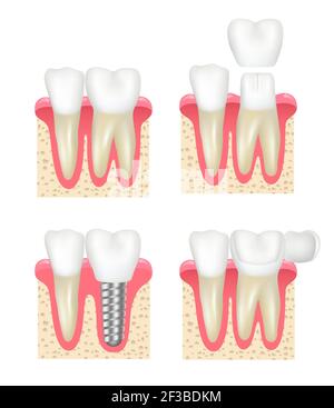 Corona dentale. Impiallacciatura dentaria impianti stomatologia cavità sana raccolta vettoriale dentista Illustrazione Vettoriale