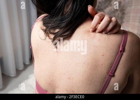 Donne con sintomi di orticaria pruriginosa o reazione allergica sulla pelle. Eruzione cutanea rossa sul corpo femminile. Concetti di allergia, malattie della pelle e salute c Foto Stock