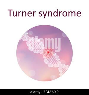 Sindrome di Turner, illustrazione Foto Stock