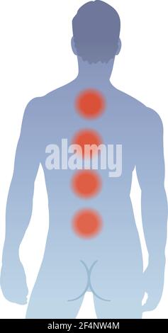 L'illustrazione mostra le principali aree di dolore alla schiena dell'uomo, causate dal mieloma multiplo. Illustrazione Vettoriale