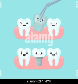 Concetto di stomatologia dell'impianto e dell'estrazione dei denti, simpatico illustrazione vettoriale dell'impianto dei denti colorati Illustrazione Vettoriale