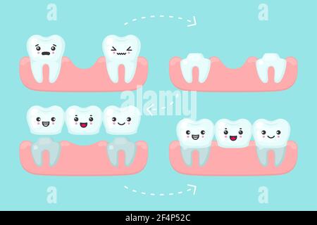 Impostazione del ponte dentale, illustrazione del concetto vettoriale di stomatologia dentale Illustrazione Vettoriale