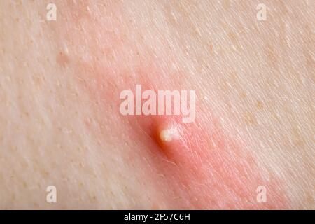 purulento pimple su pelle umana infiammata primo piano, salute del corpo teen e problemi. Foto Stock