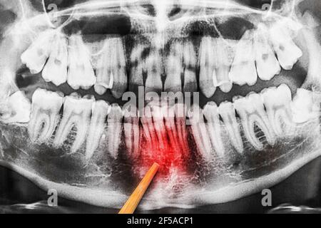 Il processo di curvatura dei denti nella mascella inferiore sull'immagine radiografica della cavità orale, primo piano. Foto Stock