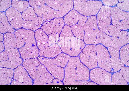 Nervo ottico umano, micrografia leggera Foto Stock