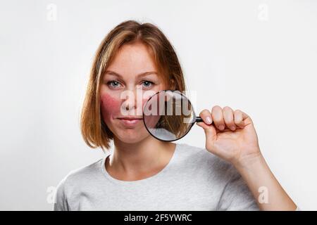 Ritratto di una giovane donna che mostra arrossamento sulle guance, attraverso una lente di ingrandimento. Sfondo bianco. Il concetto di rosacea e coupérose. Foto Stock