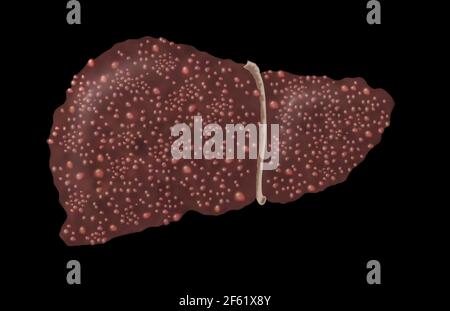 Illustrazione del fegato cirrotico Foto Stock