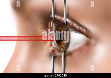 Chirurgia oculare laser Foto Stock