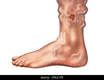 Ulcera cutanea da vena varicosa sulla caviglia Foto Stock