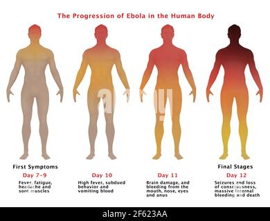 Progressione di Ebola, illustrazione Foto Stock