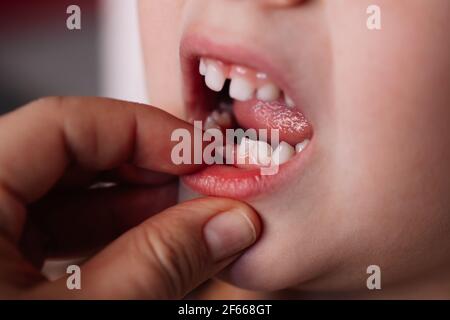 primo piano di una bocca aperta e di una mano della madre che tira fuori il primo dente del bambino Foto Stock
