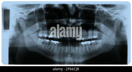 Foto a raggi X di denti umani malati con riempimento dentale Foto Stock