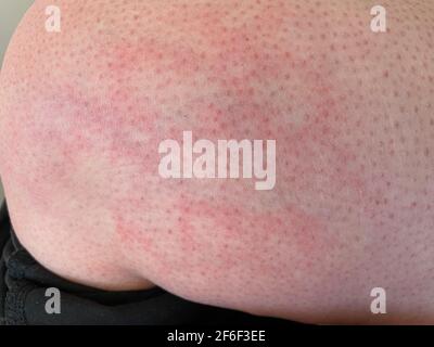 Pelle chiazzata calore eruzione cutanea orticaria reazione allergica al ginocchio primo piano immagine di riferimento di blotchy chiazzata pelle rossa eritema ab igne noto anche come EAI Foto Stock