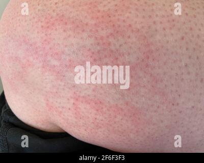 Pelle chiazzata calore eruzione cutanea orticaria reazione allergica al ginocchio primo piano immagine di riferimento di blotchy chiazzata pelle rossa eritema ab igne noto anche come EAI Foto Stock