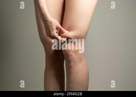 Schiacciamento delle pieghe di grasso sopra le ginocchia, vista 3/4. Donna`s fianchi closeup studio RAW girato su sfondo grigio. Dieta e concetto di perdita di grasso. Foto Stock
