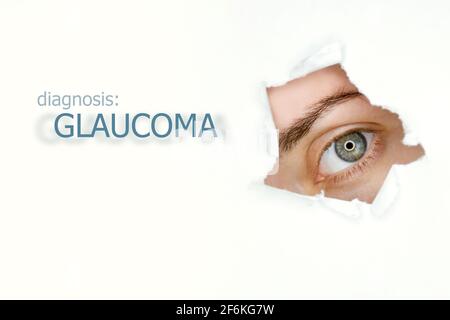 Donna`s occhio guardando trogolo lacerato buco in carta, parola Glaucoma a sinistra. Modello di concetto di malattia degli occhi. Sfondo bianco isolato. Foto Stock