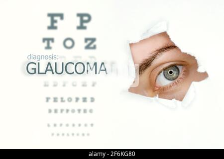 Donna`s occhio guardando trogolo lacerato foro in carta, prova dell'occhio e parola Glaucoma a sinistra. Modello di concetto di malattia degli occhi. Sfondo bianco isolato. Foto Stock