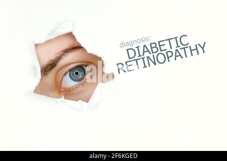 Donna`s occhio guardando trogolo lacerato buco in carta, parole retinopatia diabetica a destra. Modello di concetto di malattia degli occhi. Sfondo bianco. Foto Stock
